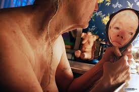 Xơ cứng rải rác - Hình ảnh minh họa